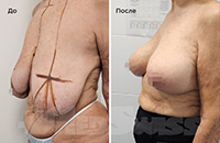 Уменьшение груди, 4 недели после операции. Фото 2/2. Врач Нестерук О.Л.