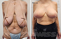 Уменьшение груди, 4 недели после операции. Фото 1/2. Врач Нестерук О.Л.