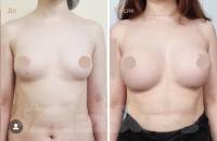 Увеличение груди 1/3. Результат через 6 месяцев после операции. 
Врач Распопина Т.А.