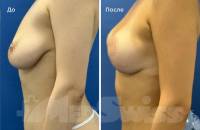 Подтяжка и увеличение груди с имплантами. Врач Маркин М.А.
