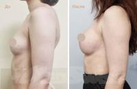 Увеличение груди 3/3. Результат через 6 месяцев после операции. 
Врач Распопина Т.А.