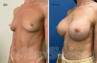 Увеличение груди круглыми имплантами 2/3. Врач Дощук А.И.
Результат через 3 месяца.