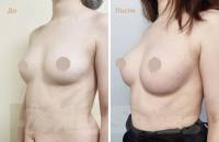 Увеличение груди 2/3. Результат через 6 месяцев после операции. 
Врач Распопина Т.А.