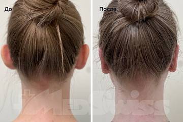 Коррекция лопоухости – Фото до и после Коррекция лопоухости фото до и после операции
