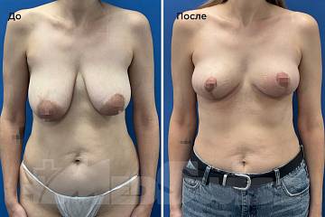 Подтяжка груди фото до и после операции