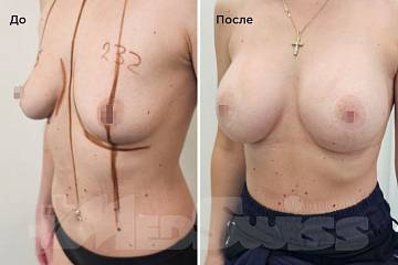 Увеличение груди с ареолярной подтяжкой фото до и после операции