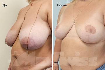 Уменьшение груди фото до и после операции