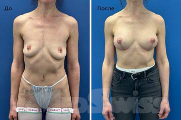 Подтяжки груди на импланте фото до и после операции
