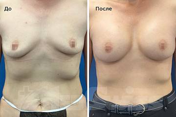 Увеличение груди фото до и после операции