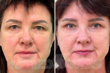 Эндоскопическая подтяжка лба и круговая блефаропластика фото до и после операции