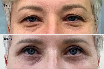 Верхняя и нижняя блефаропластика, результат через 1 месяц фото до и после операции