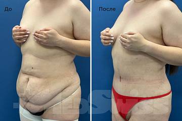 Абдоминопласика, липосакция и подтяжка лобка фото до и после операции