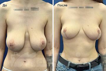 Уменьшение груди фото до и после операции