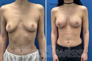 Увеличение груди фото до и после операции