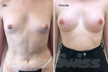 Увеличение груди фото до и после операции