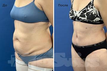 Результат абдоминопластики через три недели фото до и после операции