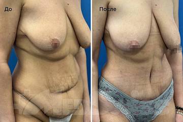 Абдоминопластика с переносом пупка фото до и после операции
