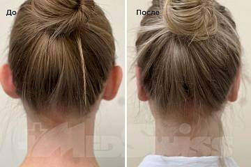 Коррекция лопоухости фото до и после операции