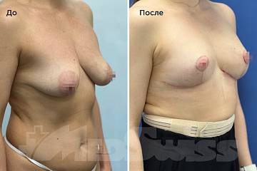 Подтяжка груди фото до и после операции