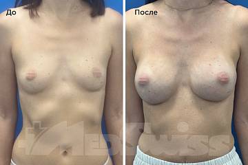 Увеличение груди фото до и после операции