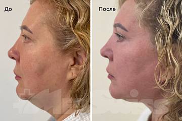 Фейслифтинг и пластика шеи фото до и после операции