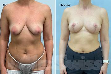 Подтяжки груди фото до и после операции