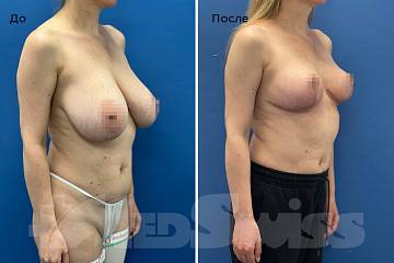Уменьшение груди фото до и после операции