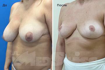 Уменьшение груди фото до и после операции