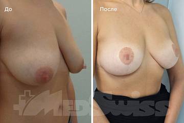 Подтяжка груди - результат через 8 лет фото до и после операции