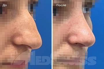 Ринопластика фото до и после операции