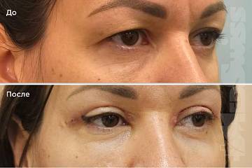 Верхняя блефаропластика фото до и после операции