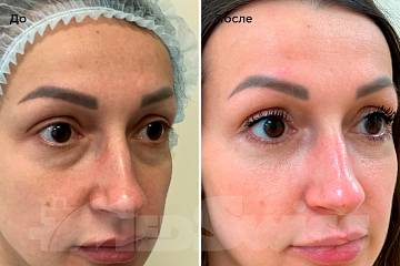 Нижняя блефаропластика фото до и после операции