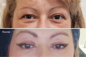 Верхняя блефаропластика фото до и после операции