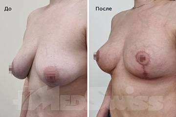 Подтяжка груди – Фото до и после Подтяжка груди фото до и после операции