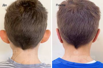 Коррекция лопоухости – Фото до и после Коррекция лопоухости фото до и после операции