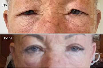 Верхняя блефаропластика фото до и после операции