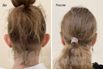 Коррекция лопоухости фото до и после операции