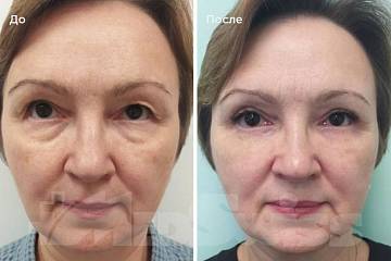 Круговая блефаропластика – Фото до и после Круговая блефаропластика фото до и после операции