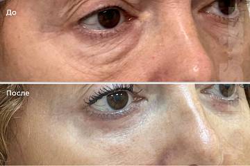 Нижняя блефаропластика фото до и после операции