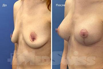Подтяжка груди на имплантах фото до и после операции